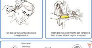 Anatomy of Free Loop Earplugs