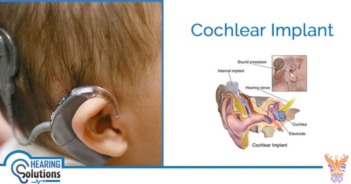 Tech Trends Cochlear Implants